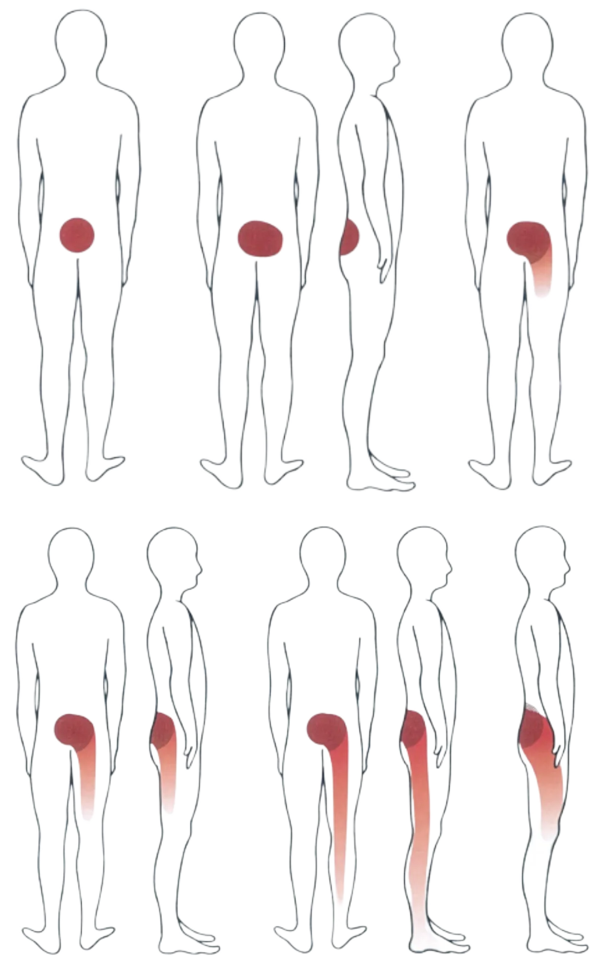 Lower Back Pain and Sciatica diagram